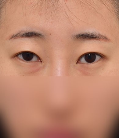 눈재수술(절개)+눈매교정+다이아트임