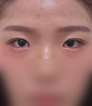 자연유착+눈매교정+앞트임