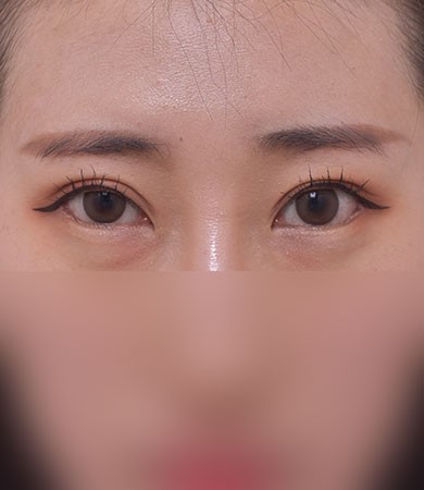 눈재수술(절개)+눈매교정+다이아트임