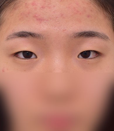 자연유착+눈매교정+앞트임