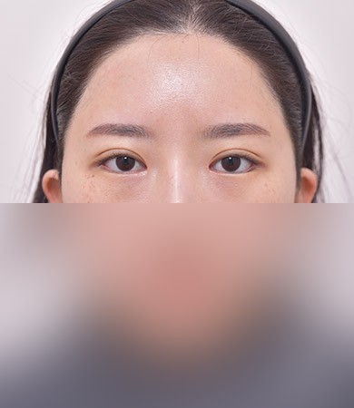눈재수술(자연유착)+눈매교정+앞트임
