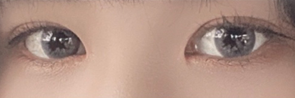 자연유착 전후사진