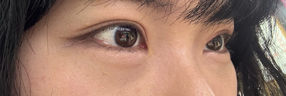 눈밑지방재배치 전후사진