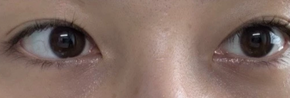 눈밑지방재배치 전후사진
