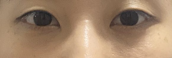 눈밑지방재배치 전후사진