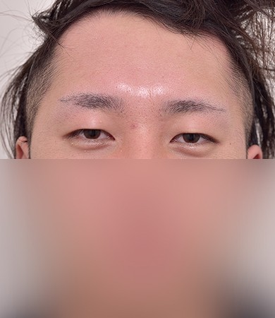 자연유착+눈매교정