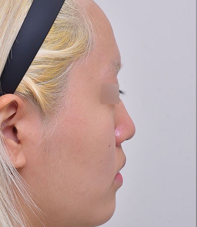 무보형물코성형 + 매부리교정 + 비중격