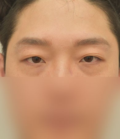 눈성형(자연유착)+눈매교정
