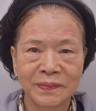 안면거상