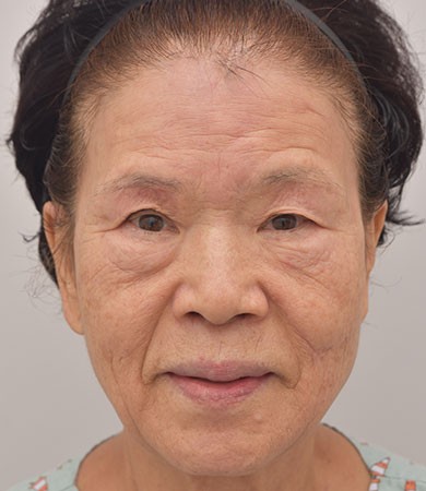 안면거상