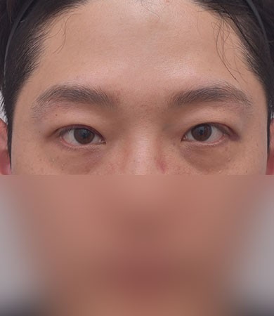 눈성형(자연유착)+눈매교정