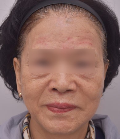 안면거상