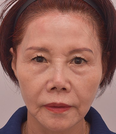 안면거상
