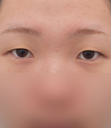 눈성형(절개)+눈매교정+앞트임