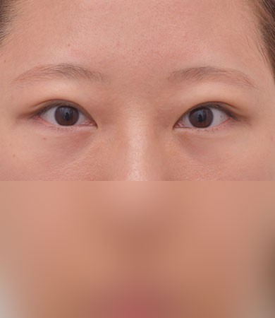눈밑지방재배치