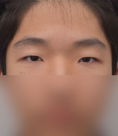눈성형(자연유착)+눈매교정+앞트임