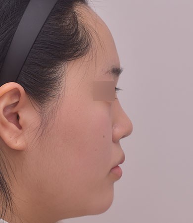 무보형물코성형 + 매부리교정 + 비중격